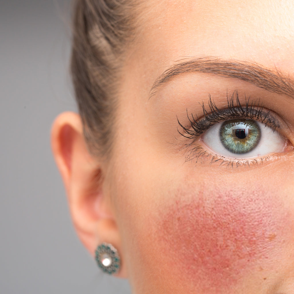 A Comprehensive Guide to Rosacea