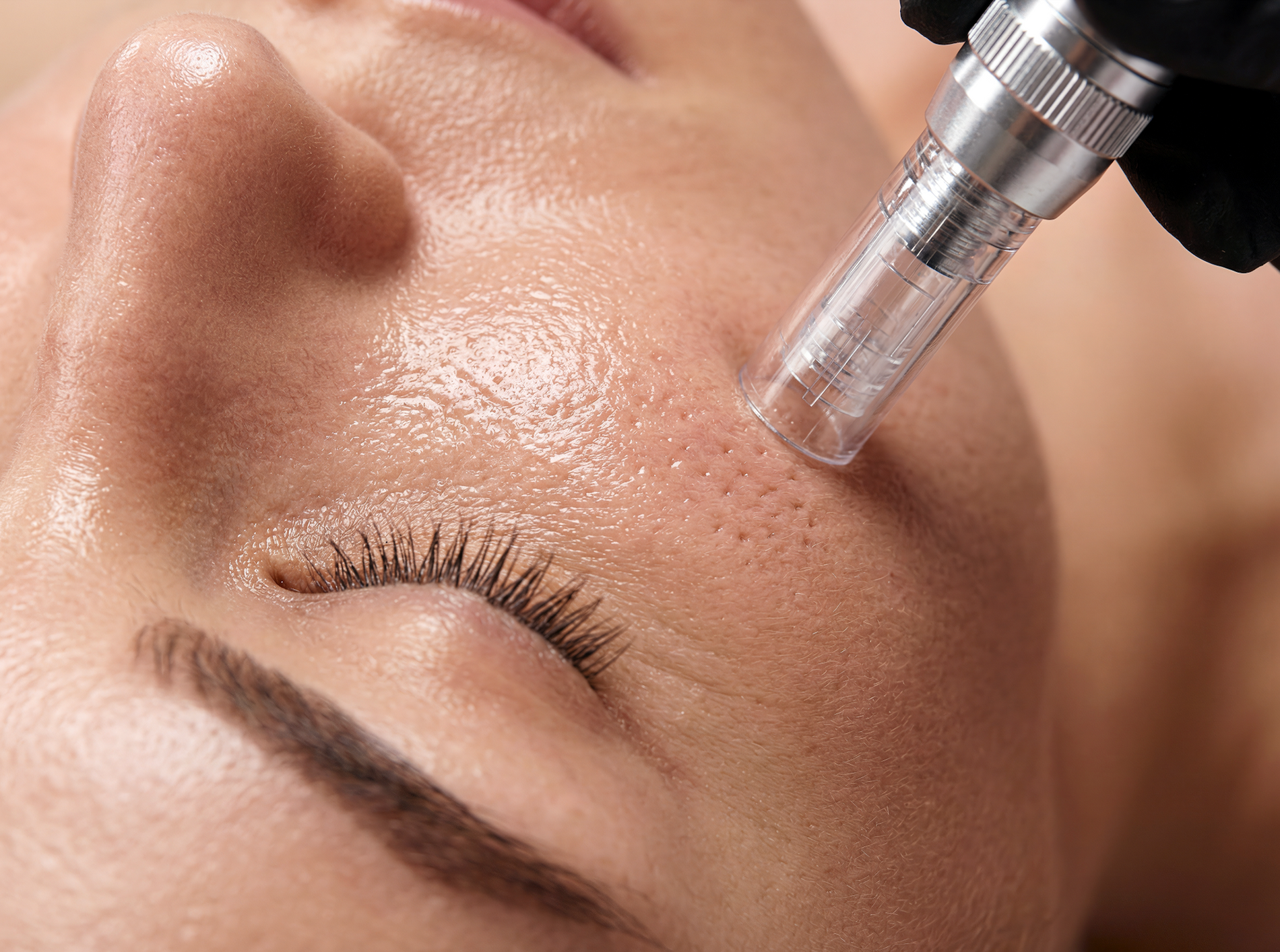 Microneedling Aftercare: Your Complete Guide to Skin Healing